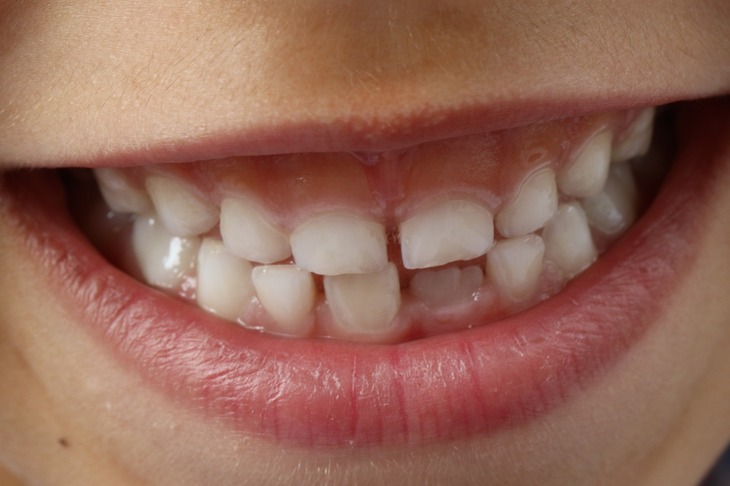 How Do Teeth Decay?
